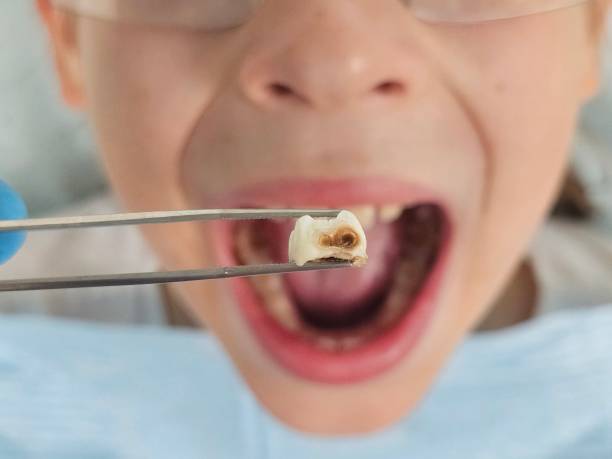 Best Urgent Tooth Repair  in Elk Point, SD